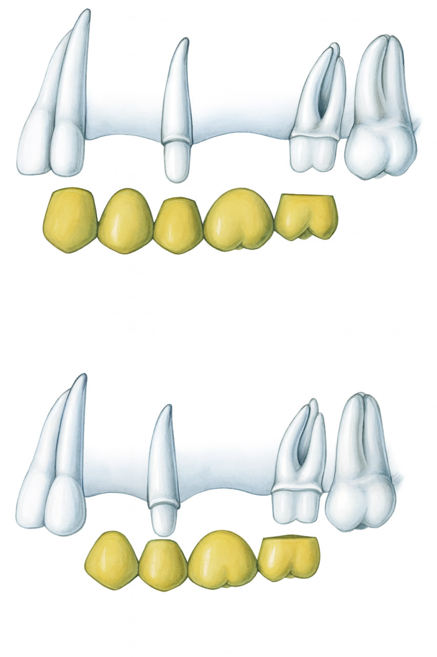 Ante’s Law in Fixed Dental Prosthodontics post thumbnail image